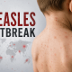 Child's back with red measles rash; bold 'MEASLES OUTBREAK' text and world map graphics in the background (informative banner).